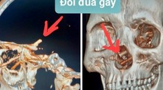 Muž žil mesiace s bolesťami hlavy. Keď si lekári pozreli CT snímku, neveriacky si pretierali oči