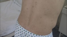 V Európe sa dramaticky rozšíril svrab. Alarmujúce čísla hlási aj jedna z vyhľadávaných destinácií