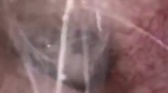 Muža svrbelo ucho. Lekári zostali zhrození, keď zistili, čo sa mu v ňom mrví