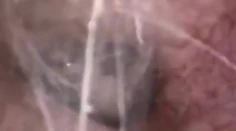 Muža svrbelo ucho. Lekári zostali zhrození, keď zistili, čo sa mu v ňom mrví