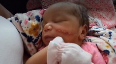 Nadšenie a radosť vystriedalo zdesenie. Dievčatko sa narodilo s obrovskou ranou na tvári