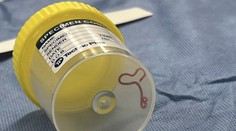 FOTO:  Lekári vyoperovali z mozgu seniorky živého osemcentimetrového červa