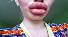 Dievča chcelo byť viac trendy. Dnes má také veľké pery, že ich nevie spojiť