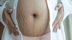 Lekári hovoria o epidémii: Obezita ohrozuje tehotné Slovenky aj ich deti