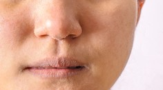 Šupiny na tvári, popraskané pery či tvorba vrások. Naučte sa starať o pleť aj v chladnom počasí