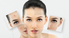 Máte akné? Zverte sa do rúk iba lekárom