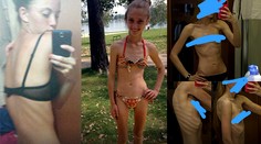 Mala 14 a vážila 29 kíl. Posadnutosť chudnutím ich priviedla na psychiatriu