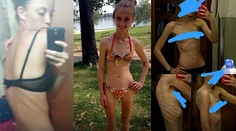 Mala 14 a vážila 29 kíl. Posadnutosť chudnutím ich priviedla na psychiatriu