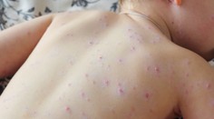 V Británii sa objavilo veľmi vzácne ochorenie, prejavuje sa bolestivými pľuzgiermi