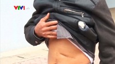 Muž žil 18 rokov s nožnicami v bruchu. Ukázal to röntgen po nehode