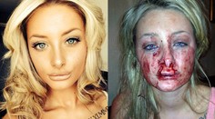 Žiarlivý priateľ dohrýzol nádhernú priateľku. Na súde sa usmieval