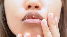 Suchá a podráždená pokožka po zime. Ako ju udržať hydratovanú a zdravú?