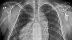 V šoku bol lekár aj sám pacient: Muž mal srdce na nesprávnom mieste