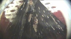 Začala sa sezóna vší. Toto by ste mali o nich vedieť