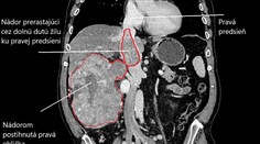 FOTO: V Rooseveltovej nemocnici vyoperovali nádor veľkosti rugbyovej lopty
