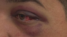 Agresívny vodič v kolóne: Vytiahol bejzbalku a Patrikovi dolámal tvárové kosti