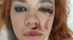 Speváčka zo skupiny Peter Bič Project mala nehodu! Zverejnila desivú fotku