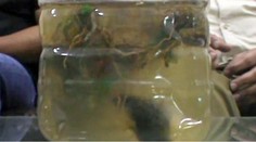 Dievčatku vytiahli zo žalúdka obrovskú guču vlasov