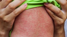 Epidémia osýpok sa už v okrese Trebišov skončila, posledné prípady sú z marca