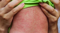 Epidémia osýpok na východe pokračuje, nakazili sa ďalší dvaja ľudia