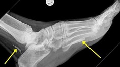 Muž mal v nohe metrového červa celé štyri roky!