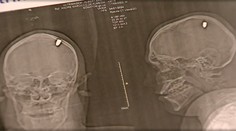 Mladík žil štyri dni s guľkou v lebke. Vôbec o tom nevedel, myslel si, že ho trafil kameň