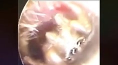 VIDEO: Žena sa sťažovala na bolesť ucha. Doktor v ňom našiel zahniezdeného malého tvora