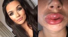 Toto nie sú napichané pery. Tínedžerke príšerne opuchli ústa po bielení zubov