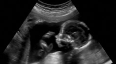 Žena musí vynosiť choré dieťa, aby ho po pôrode pochovala. Pre prísny potratový zákon jej nechcú pomôcť