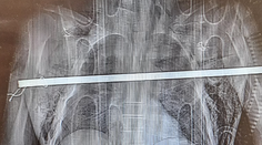 FOTO: Čech sa druhýkrát narodil. Pri páde z rebríka si privodil zranenie, s akým sa lekári ešte nestretli