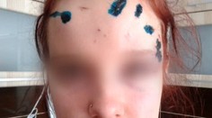 Chytili muža, ktorý znetvoril tvár 16-ročnému dievčaťu z Ružomberka