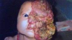 Nádor jej zakrýval tvár. Dobrá žena jej zaplatila operáciu a takto vyzerá dnes