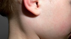 Česko hlási stovky prípadov nebezpečného ochorenia. Môže spôsobiť hluchotu či neplodnosť