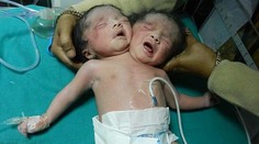 Narodilo sa bábätko s dvomi hlavami a jedným telom