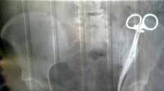 Viac ako 20 rokov má v tele chirurgické nožnice, zašili jej ich počas cisárskeho rezu