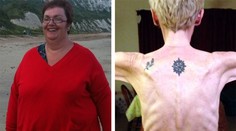 Z morbídne obéznej ženy sa stala vyziabnutá anorektička