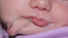 Dievčatko sa narodilo s dvomi ústami. Môže za to jedna z najvzácnejších genetických porúch