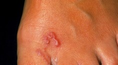 Pozor na nechcený suvenír z dovolenky. Strašidelného tropického parazita môžete chytiť na pláži