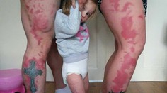 Dievčatko trápilo veľké znamienko. Rodičia si ho dali preto vytetovať