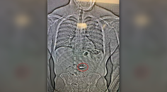 Muž mal ukradnúť luxusné náušnice za trištvrte milióna dolárov. Našli sa na röntgenovej snímke v jeho orgáne