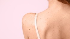 Ako chrániť znamienka pred slnkom? Tu je niekoľko užitočných rád