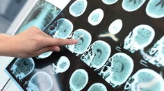 Vedci opísali neobvyklý prejav zákernej choroby. Pacienta (80) desí málo známe déjà vécu