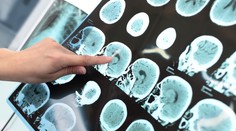 Vedci opísali neobvyklý prejav zákernej choroby. Pacienta (80) desí málo známe déjà vécu
