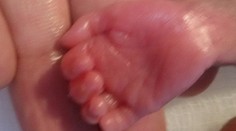 Najmenšie dieťa na svete po operácii srdca. Bolo veľké ako dlaň