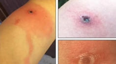 Nové vírusové ochorenie má prvú obeť. Všetko sa zrejme začalo škrabancom od mačky