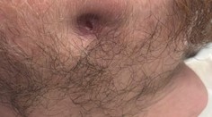 Strach zo zubárov ho stál veľa: Zanedbaný zubný kaz spôsobil mladému mužovi hotové peklo