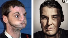 Podstúpil najzložitejšiu transplantáciu v histórii a je z neho model