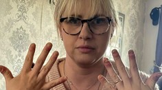 Žena roky nosila gélové nechty, teraz to horko ľutuje. Znetvorené prsty už takmer nedokáže ohnúť