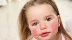 Imunologička: Deti majú byť trochu špinavé aj choré. Tým, že žijeme príliš čisto, narastá počet alergií (rozhovor)