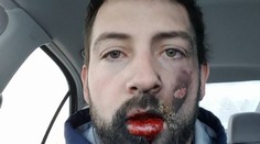 Muž chcel prestať fajčiť, e-cigareta mu ale spálila tvár a vylámala sedem zubov
